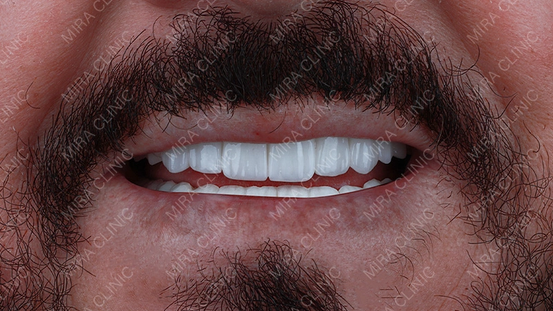 celebrity hollywood smile final result 